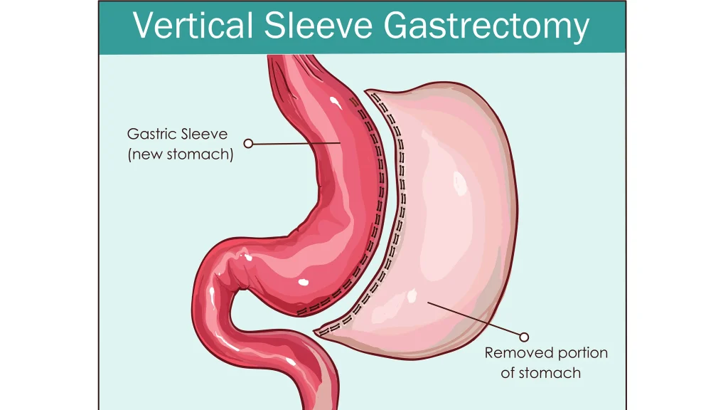 Treatment for Morbid Obesity: Laparoscopic Sleeve Gastrectomy