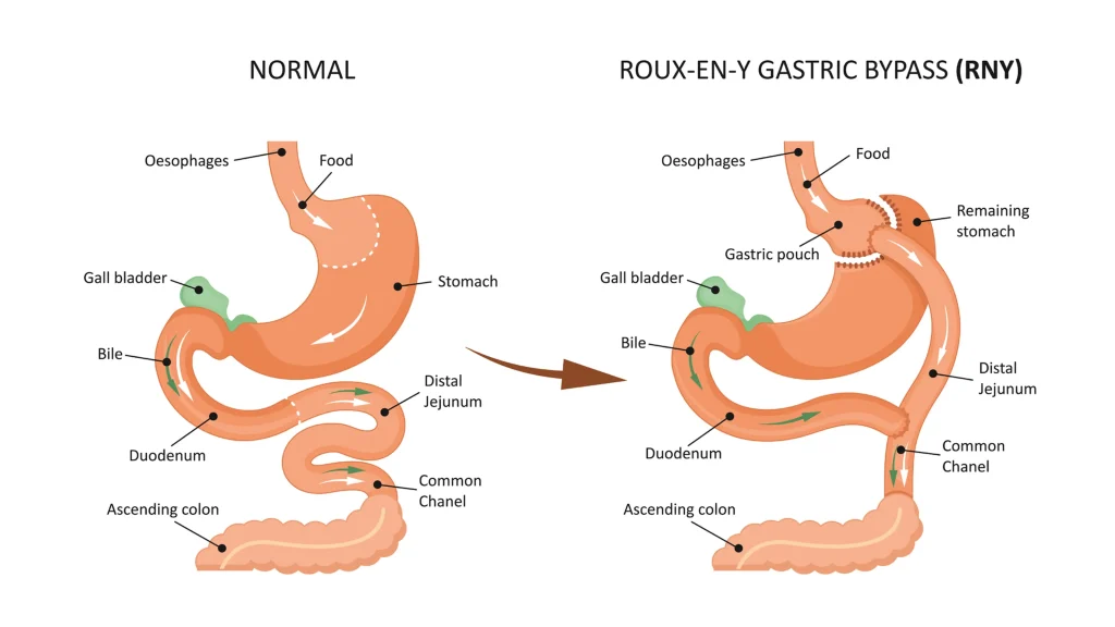 Laparsocopic Gastric Bypass